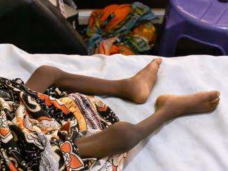 The legs of a malnourished child on a hospital bed in Nigeria.